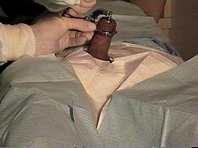 An adult man being circumcised with a Gomco clamp My gomco circ may96.jpg