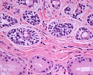 Carcinoma cistico adenoide delle ghiandole ceruminose ematossina ed eosina. Tif