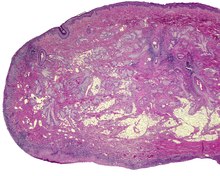 An intermediate power of a microscopic view of an accessory auricle. Ear Accessory Auricle LDRT.tif