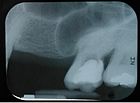 The maxillary sinus can normally be seen above the level of the premolar and molar teeth in the upper jaw. This dental x-ray film shows how, in the absence of the second premolar and first molar, the sinus became pneumatized and expanded towards the crest of the alveolar process (location at which the bone meets the gum tissue). Pneumatized max sinus.jpg