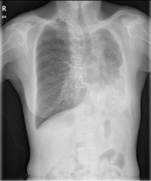 Chest X-ray showing left pulmonary agenesis with mediastinal shift and right lung hyperinflation.png