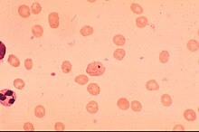 Thin blood film Smear.jpg