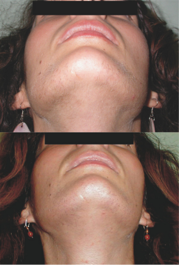 Improvement of facial hirsutism in a woman with hyperandrogenism before (top) and after (bottom) treatment with 125 mg/day flutamide and an oral contraceptive for 6 months (click image to view a larger version).[35]: 368 