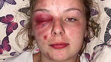 Police found the injuries Eleanor Williams posted photos of on Facebook had been self-inflicted.jpg
