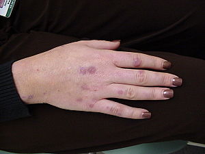 Pseudoporphyria.JPG