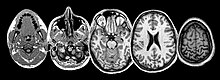 Neuroimaging sheds light on the seat of suffering MRI Head 5 slices.jpg