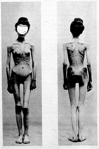 <span class="mw-page-title-main">History of anorexia nervosa</span>