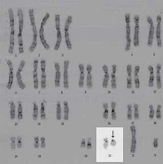 <span class="mw-page-title-main">Ring chromosome 22</span> Rare chromosomal disorder