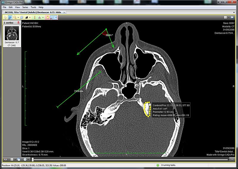 File:Ginkgo CADx displaying a CT.jpg