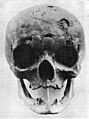 Effect of syphilis on the skull.