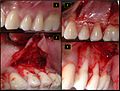 Thumbnail for Subepithelial connective tissue graft