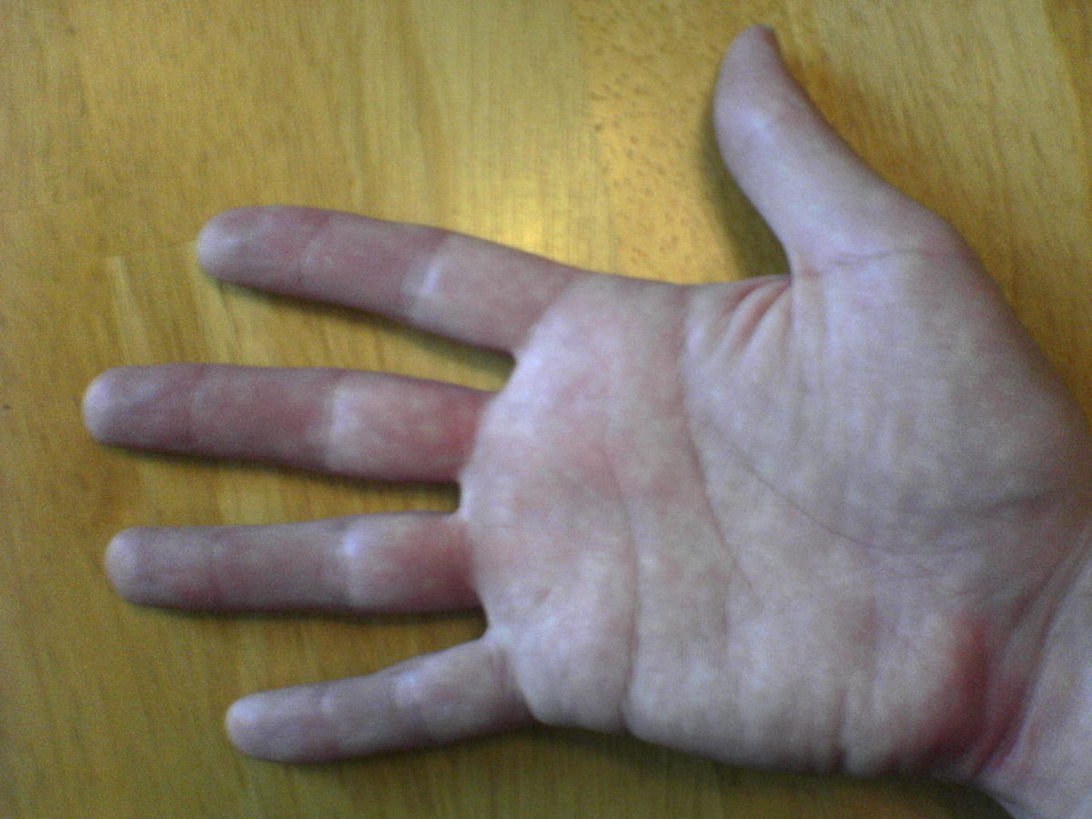 File:Broken right hand in orange cast.jpg - Wikipedia