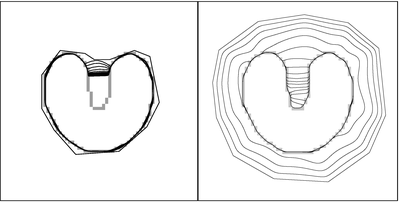 Fig. 3. An active contour with traditional external forces (left) must be initialized very close to the boundary and it still will not converge to the true boundary in concave regions. An active contour using GVF external forces (right) can be initialized farther away and it will converge all the way to the true boundary, even in concave regions. GVF Convergence.png