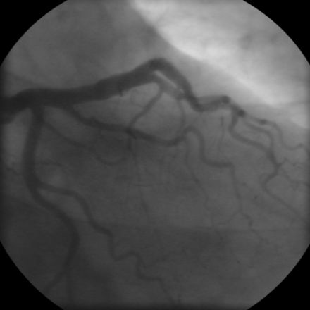 Coronary angiogram of a male