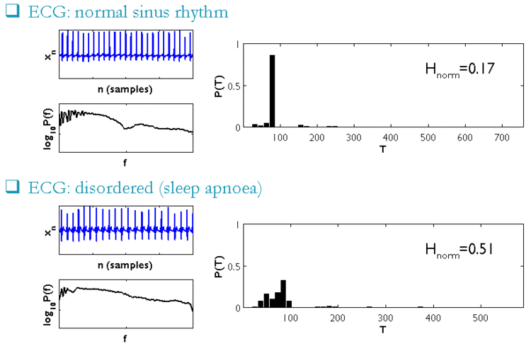 RPDE values
H
n
o
r
m
{\displaystyle H_{norm}}
for normal sinus rhythm ECG, and for ECG from a patient with sleep apnoea. The time series (plots with blue traces) and spectra (plots with black traces) are relatively difficult to distinguish, nonetheless, the RPDE values are sufficiently different that detection of the abnormality is straightforward. RPDE real.gif