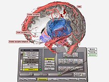 Screen Capture from the Dextroscope. This image shows a moment during the planning of a typical neurosurgical procedure involving an MRI, DTI, TMS data modalities. Dextroscope Screen Capture showing the planning of a neurosurgical tumor case.jpg