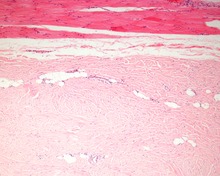 A low power of a nuchal-type fibroma showing entrapped fat. Photomicrograph of Nuchal-type fibroma H&E LDRT.tif