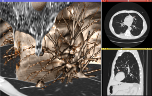 Volume rendering (left), axial cross-section (right top), and sagittal cross-section (right bottom) of a CT image of a subject with multiple nodular lesions (white line) in the lung. Visualization of Medical Imaging.png