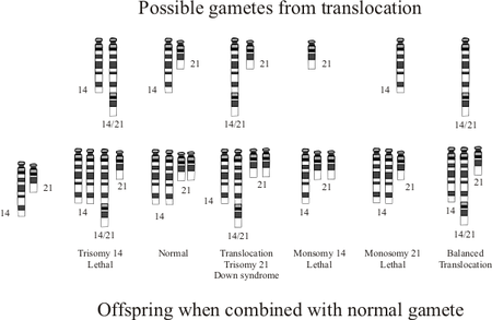 Offspring from one parent with a balanced translocation and the other parent who has normal chromosomes. Translocation Down syndrome.png