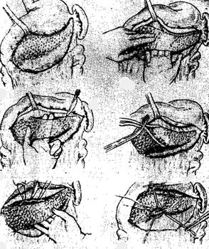 Сурет:Резекция поджелудочной желези.jpg