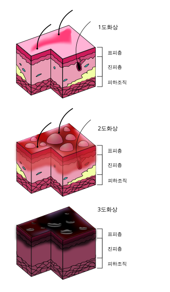 파일:Burn Degree Diagram ko.svg