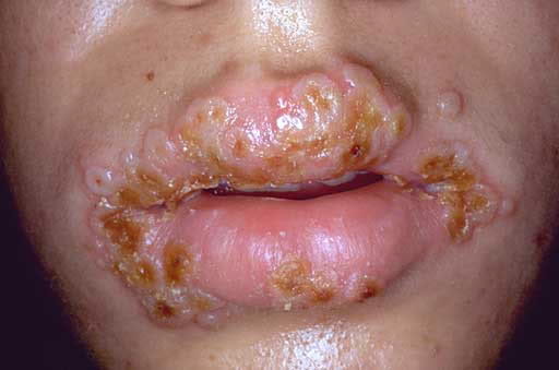 Fail:Herpes.jpg