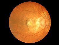 Fișier:Fundus stargardt.jpg