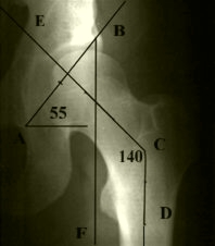 Файл:Congenital dislocation of the hip 8.jpg