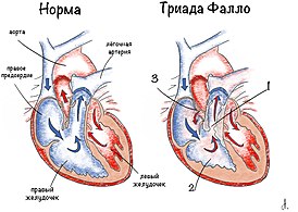 1 — стеноз лёгочной артерии, 2 — гипертрофия правого желудочка, 3 — дефект межпредсердной перегородки