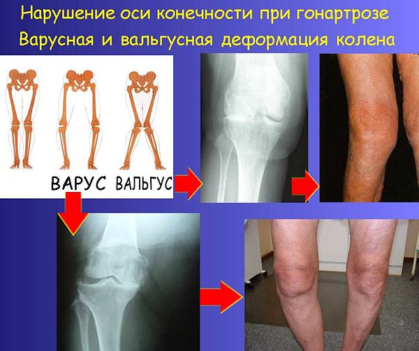 Деформирующий остеоартроз