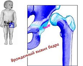 Congenital dislocation of the hip.jpg