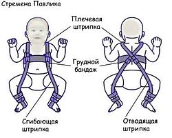 Дисплазия тазобедренных суставов у детей - передовые методы диагностики и лечения