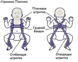 Дисплазия тазобедренных суставов у детей