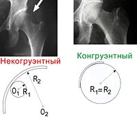 Дисплазия тазобедренных суставов у детей - Статьи Ортоленд