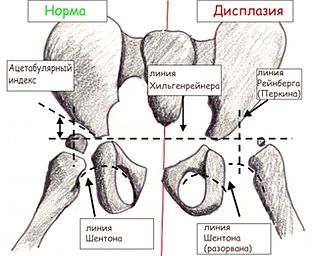 Дисплазия тазобедренного сустава – МЕДИЦИНСКИЙ ЦЕНТР ГАЛИЛЕЯ