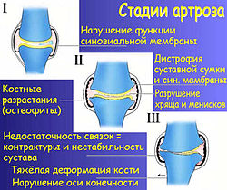 Остеоартроз плеча