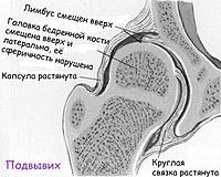 Congenital dislocation of the hip5-2.jpg