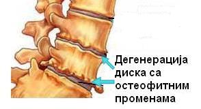 Датотека:Degenerativne promene IV diska sa osteofitima.JPG