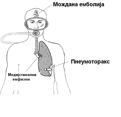 Датотека:Gasna embolija u ronilaca.gif