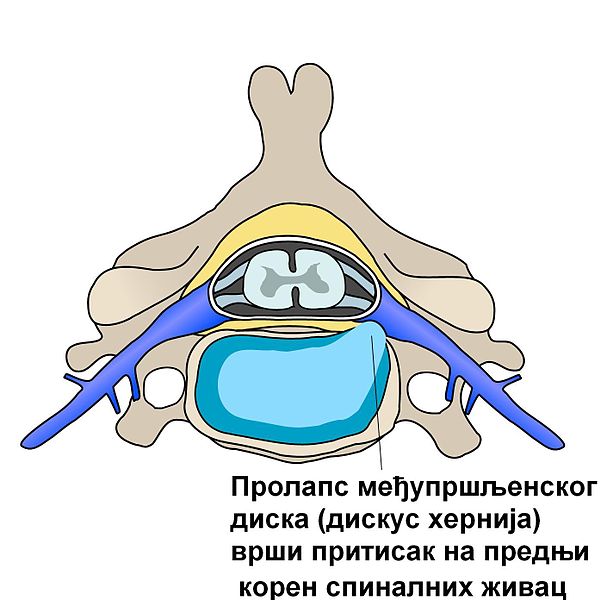 Датотека:ACDF coronal english.3.jpg