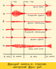 Phonocardiograms from normal and abnormal heart sounds ta.png