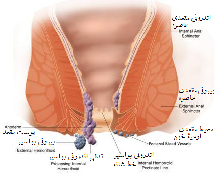 فائل:800px-Hemorrhoid.PNG