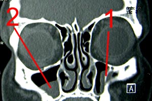 Tập tin:Sinus-2.jpg