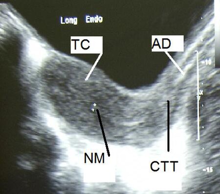 Tập_tin:Uterus-US.jpg