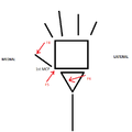 Figure 4 Coronal, dorsal view of 3 point force system acting to maintain thumb extension at MCPJ