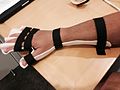 Figure 7: WHO orthosis with straps (Dorsal view)