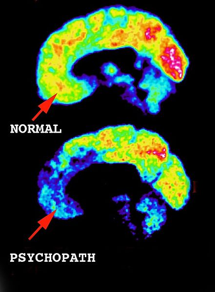 File:Psychopath brain.jpg